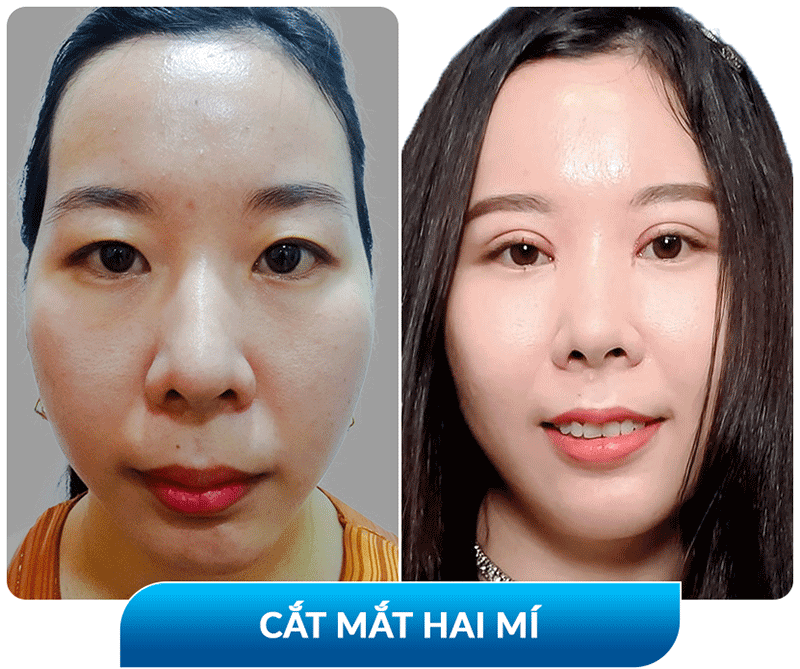 khách hàng phẫu thuật thẩm mỹ