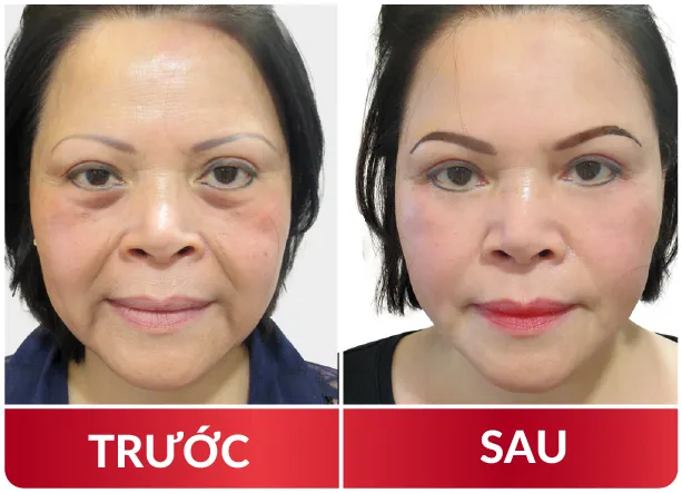 Cải Lão Gương Mặt 3M