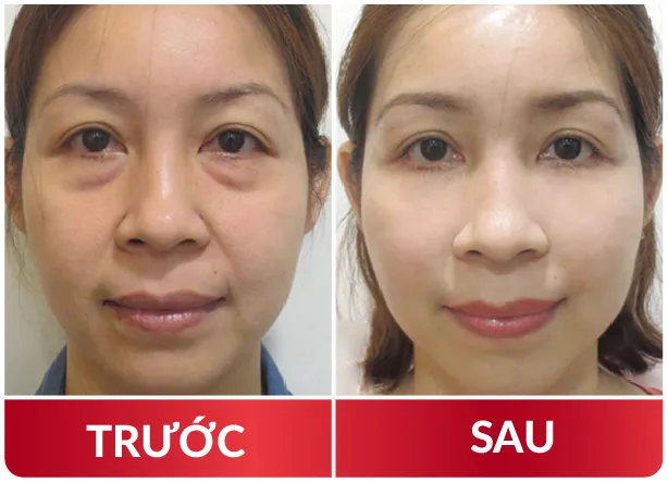 Cải Lão Gương Mặt 3M