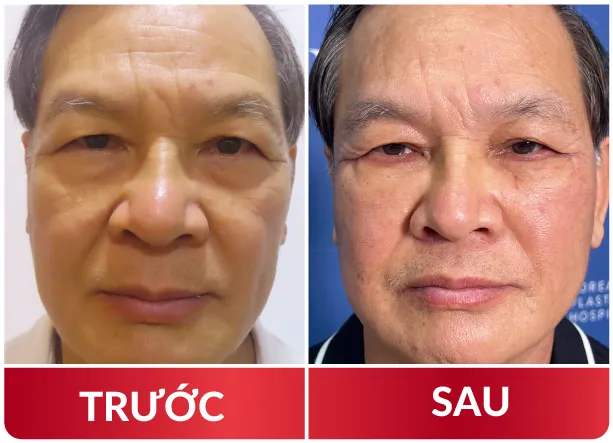 Cải Lão Gương Mặt 3M