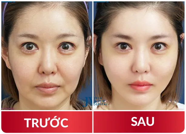 Cải Lão Gương Mặt 3M