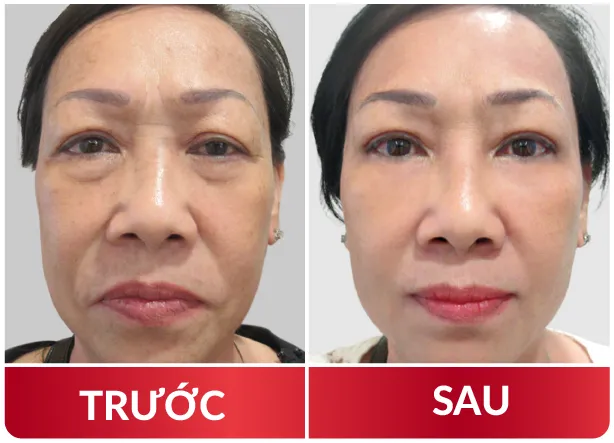 Cải Lão Gương Mặt 3M