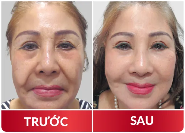 Cải Lão Gương Mặt 3M