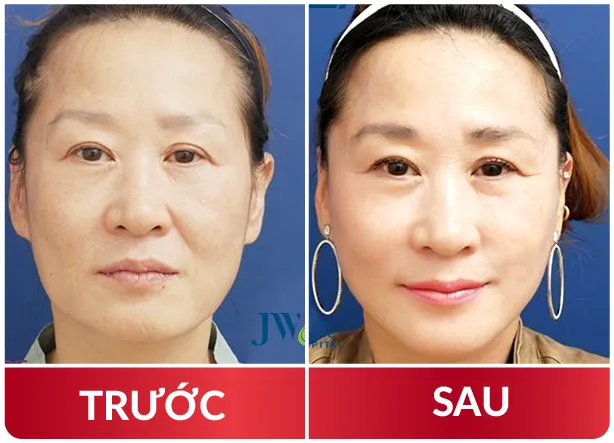 Cải Lão Gương Mặt 3M