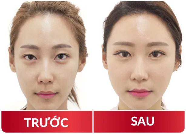 Cải Lão Gương Mặt 3M