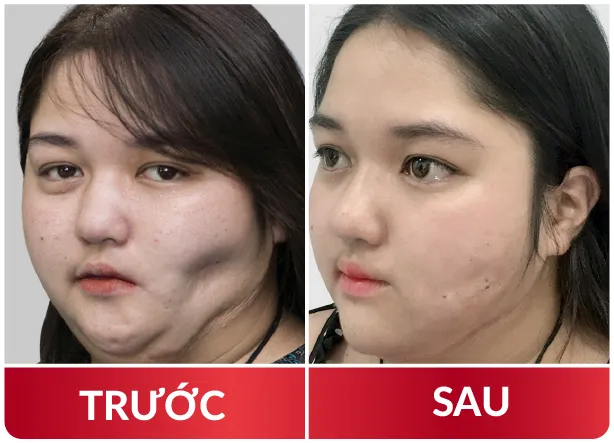 Cải Lão Gương Mặt 3M