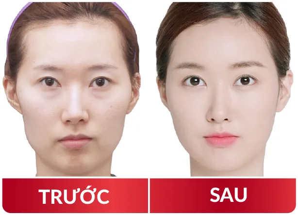 Cải Lão Gương Mặt 3M