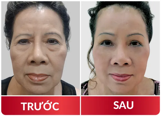 Cải Lão Gương Mặt 3M