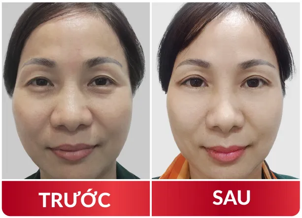 Cải Lão Gương Mặt 3M