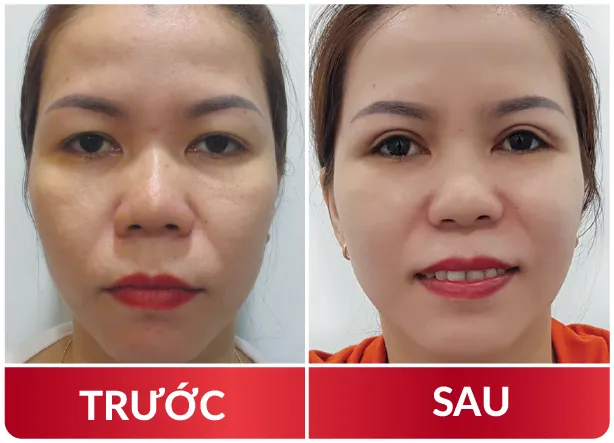 Cải Lão Gương Mặt 3M