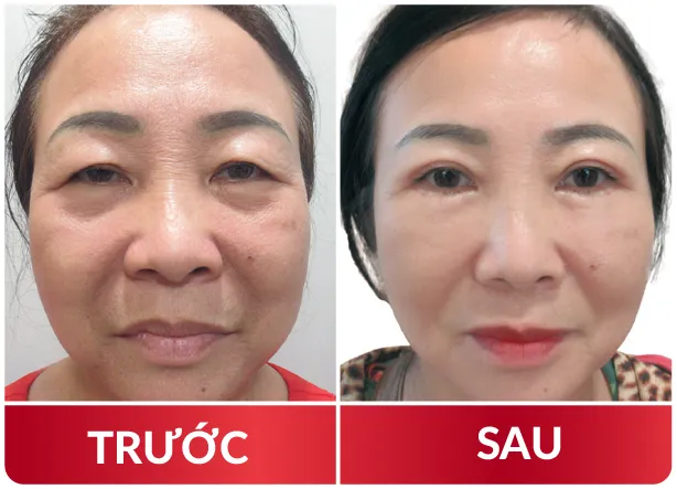 Cải Lão Gương Mặt 3M