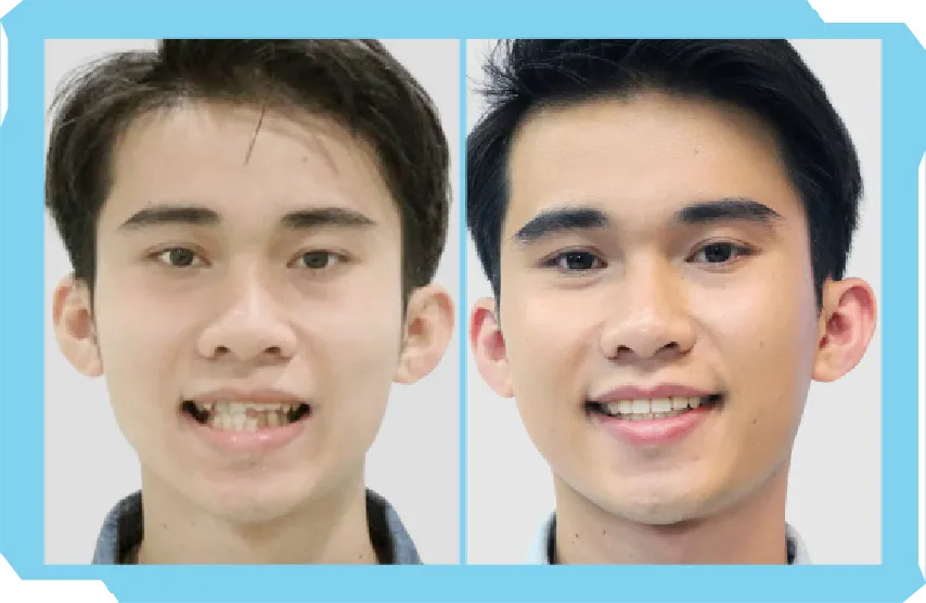 Chào Hè Cùng Niền Răng Trong Suốt AI