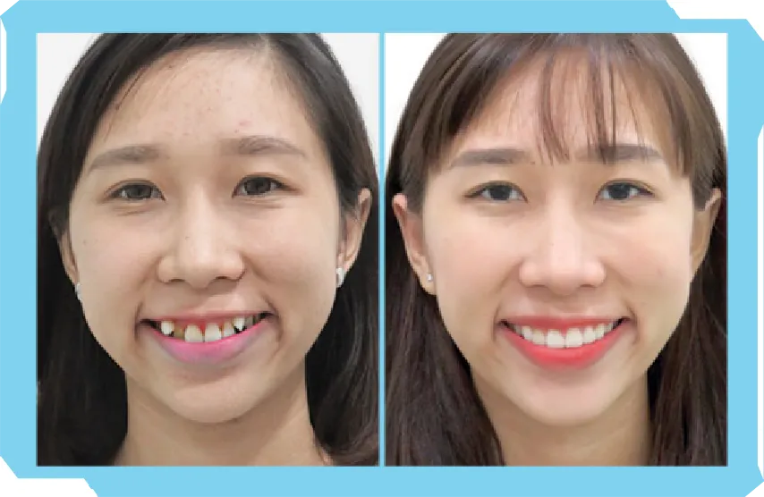 Chào Hè Cùng Niền Răng Trong Suốt AI