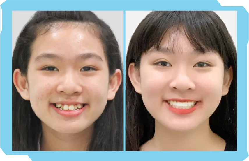 Chào Hè Cùng Niền Răng Trong Suốt AI