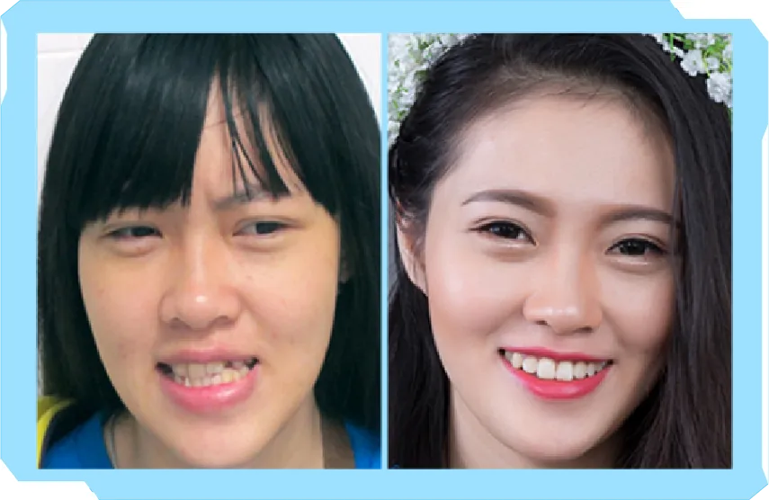 Chào Hè Cùng Niền Răng Trong Suốt AI