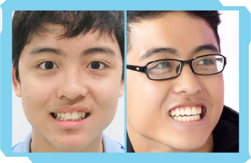 Chào Hè Cùng Niền Răng Trong Suốt AI