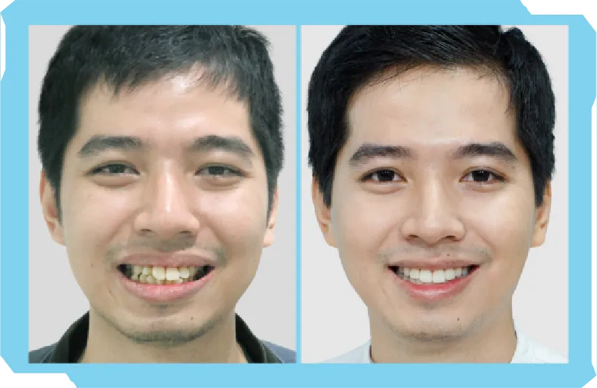 Chào Hè Cùng Niền Răng Trong Suốt AI