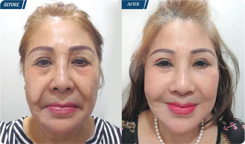 JW 23 NĂM - TIẾP NỐI GIÁ TRỊ THẨM MỸ ĐIỀU TRỊ