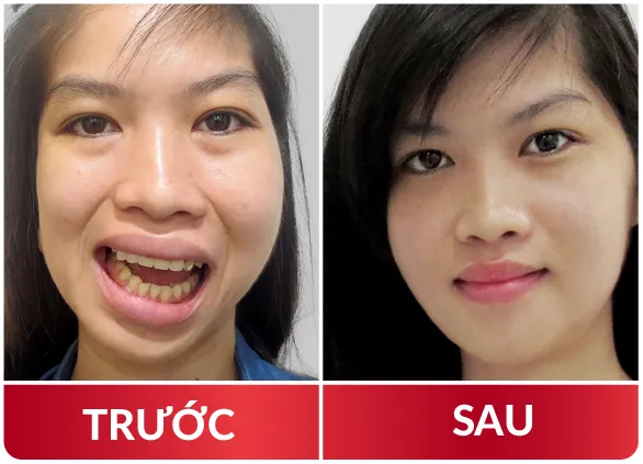 Thẩm Mỹ Hàm Mặt 2023