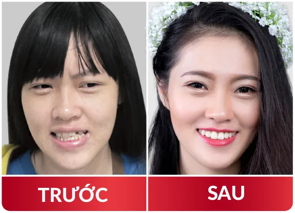 Thẩm Mỹ Hàm Mặt 2023