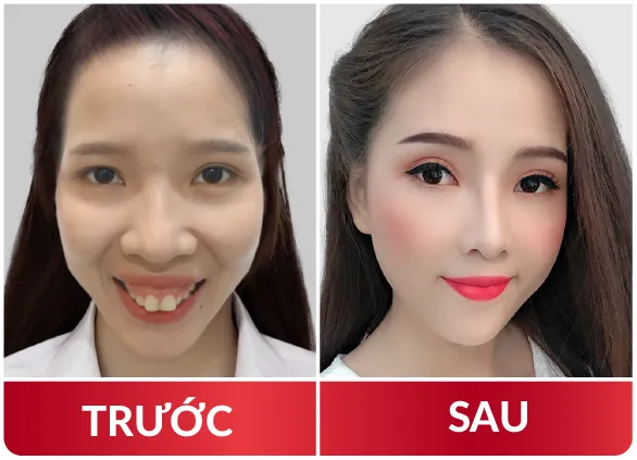 Thẩm Mỹ Hàm Mặt 2023