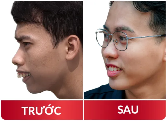 Thẩm Mỹ Hàm Mặt 2023