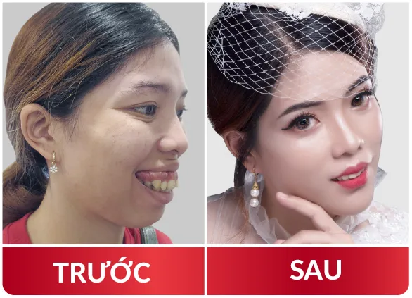 Thẩm Mỹ Hàm Mặt 2023