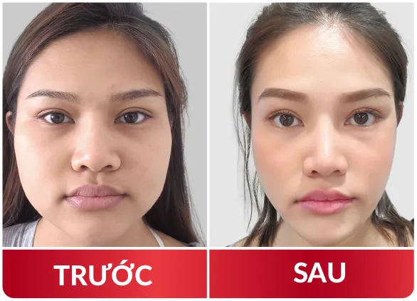 Thẩm Mỹ Hàm Mặt 2023