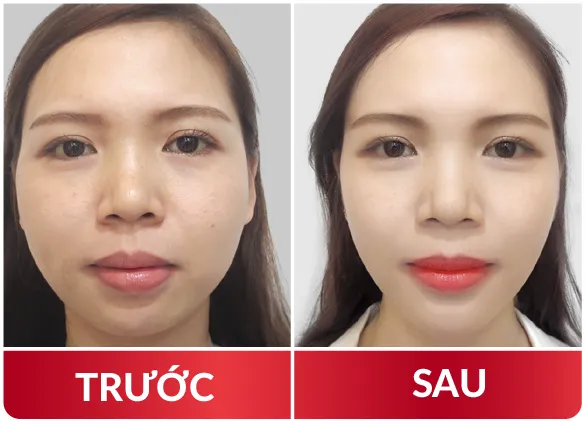 Thẩm Mỹ Hàm Mặt 2023