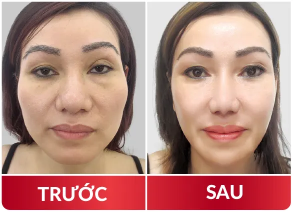 Thẩm Mỹ Hàm Mặt 2023