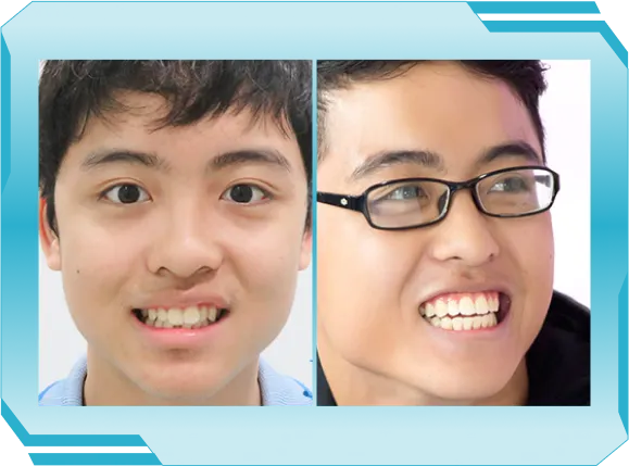 Niền răng trong suốt AI