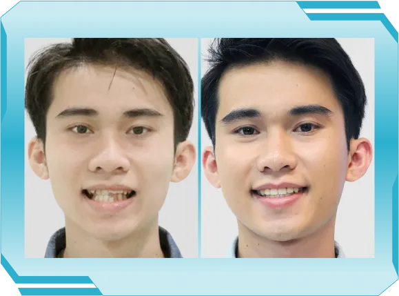 Niền răng trong suốt AI