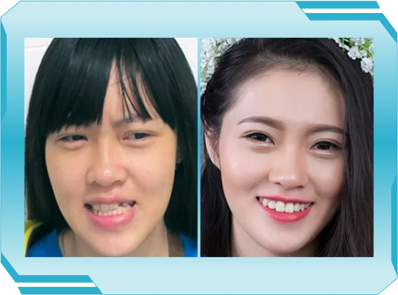 Niền răng trong suốt AI