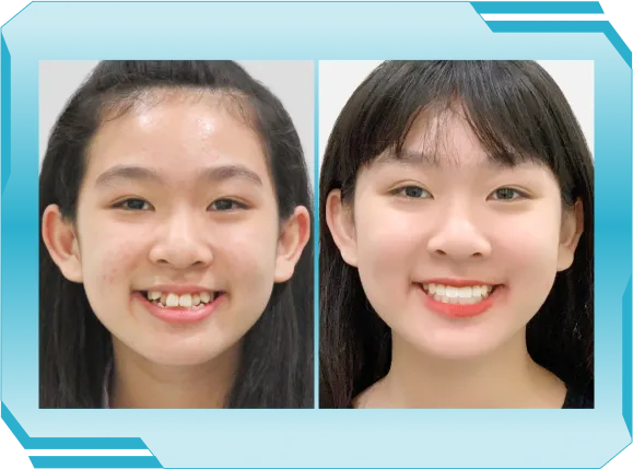 Niền răng trong suốt AI