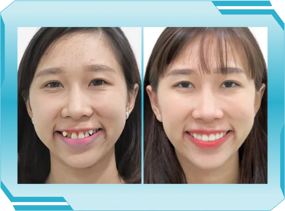 Niền răng trong suốt AI