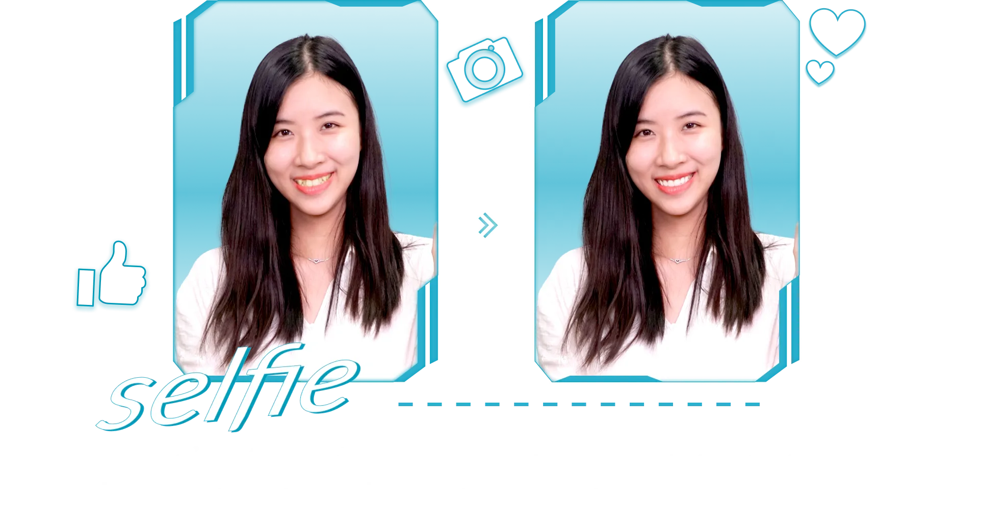 Niền răng trong suốt AI