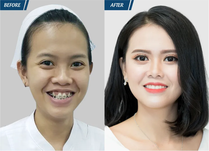 Răng Đẹp Đón Tết 2024