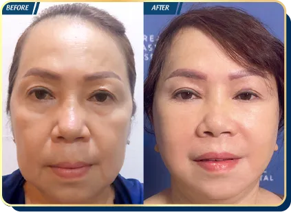 BẢNG GIÁ THẨM MỸ JW 2023