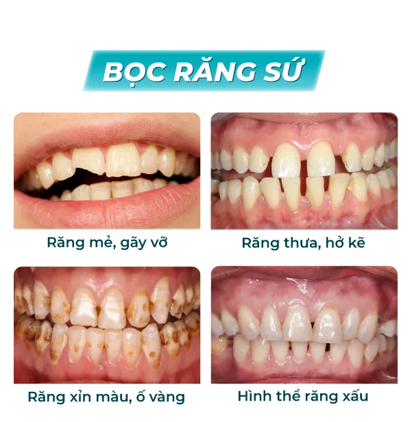 Hình ảnh chi tiết Bọc răng sứ diamond 1