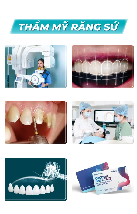 Hình ảnh chi tiết Bọc răng sứ diamond 4