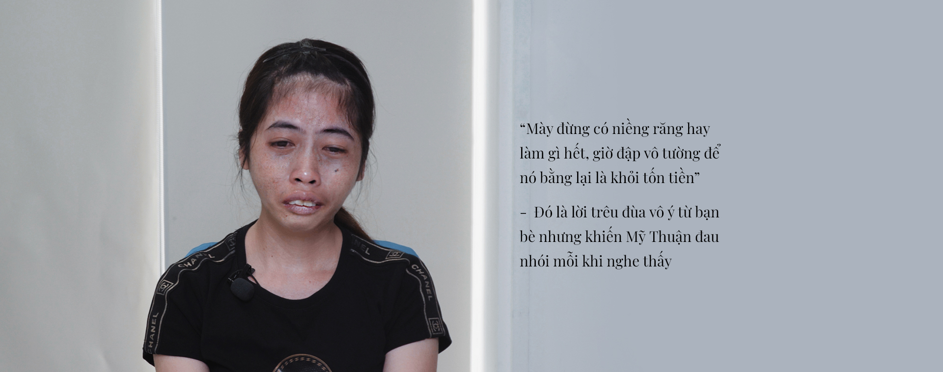 Mỹ Thuận phẫu thuật hàm hô