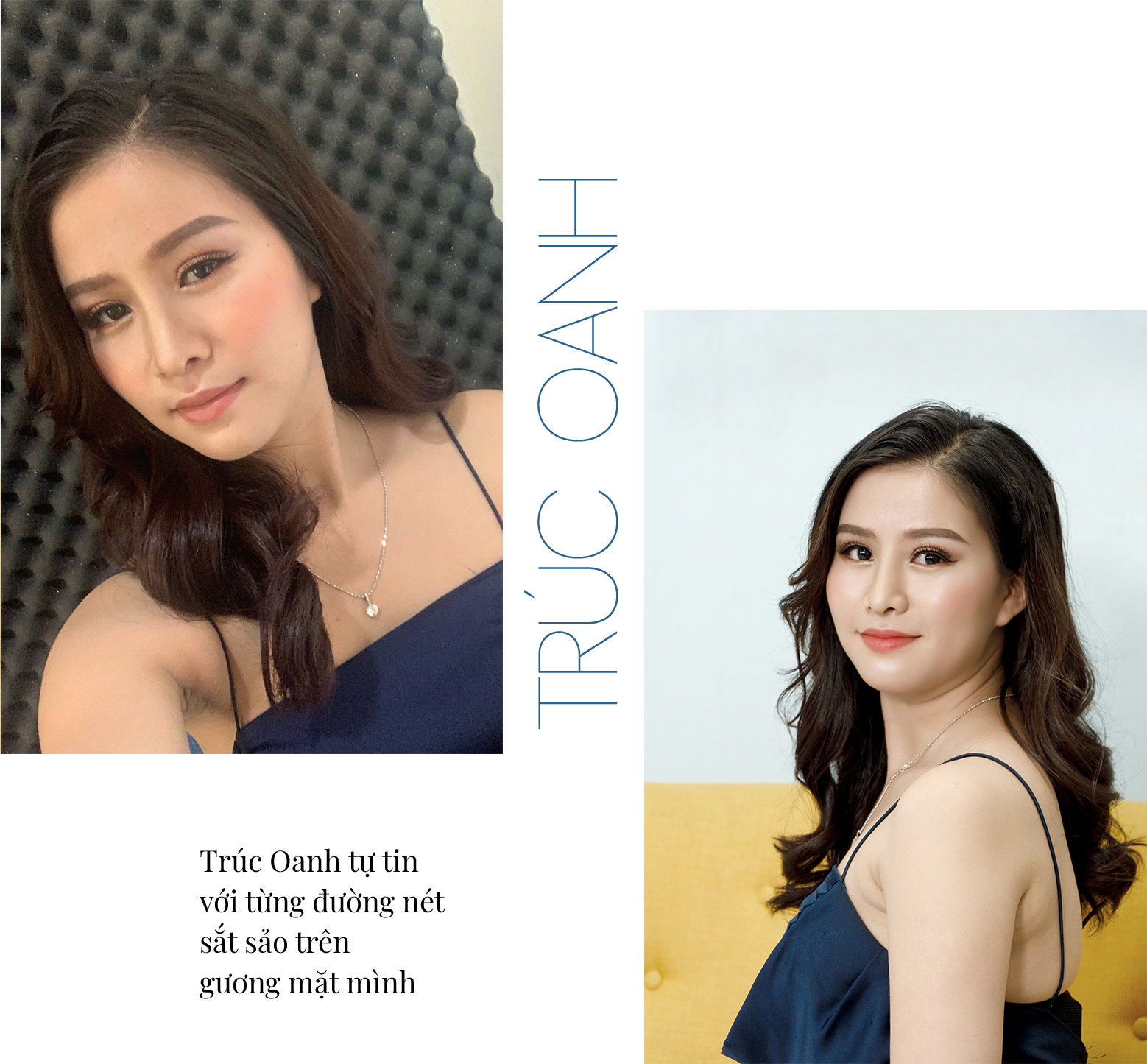 Mỹ Thuận phẫu thuật hàm hô