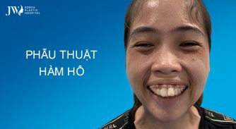 Phẫu thuật hàm hô khắc phục vĩnh viễn khuyết điểm hàm mặt