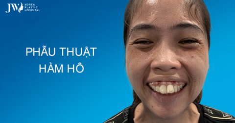 Phẫu thuật hàm hô khắc phục vĩnh viễn khuyết điểm hàm mặt