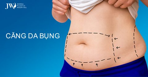 Căng da bụng – Giải pháp vàng loại bỏ vòng eo ngấn mỡ thừa