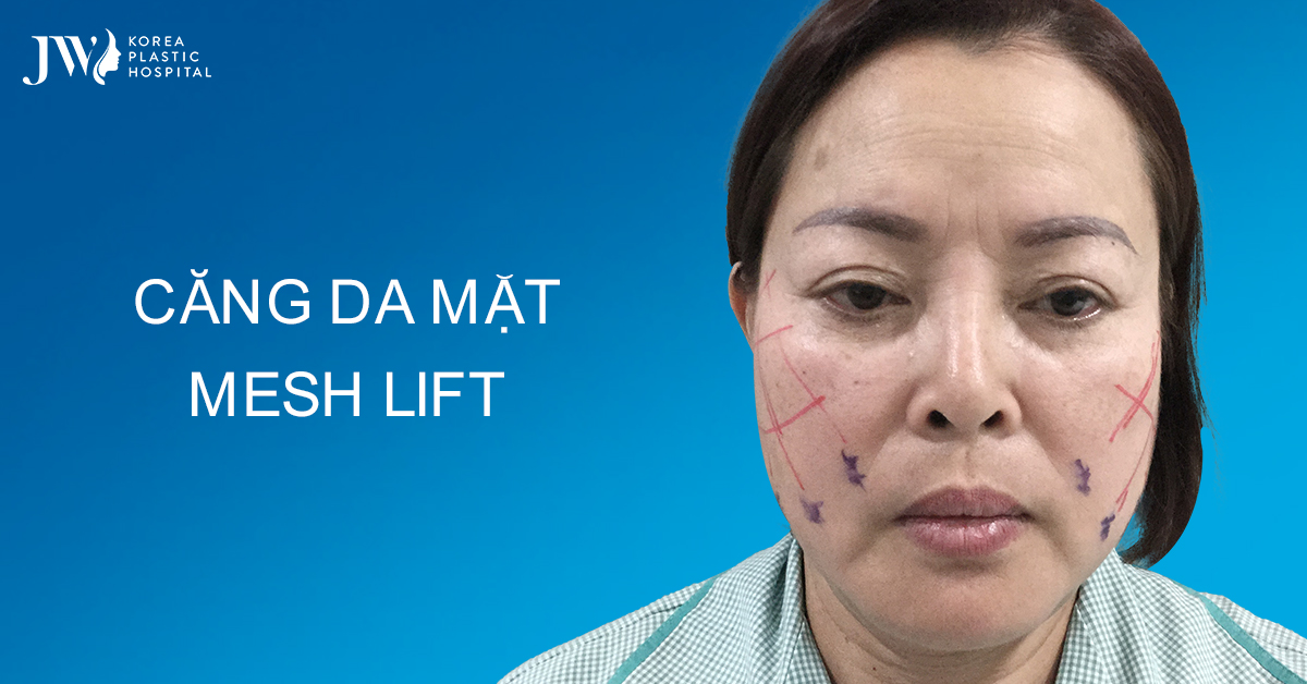 Căng da mặt Mesh Lift – Phương pháp làm đẹp không phẫu thuật