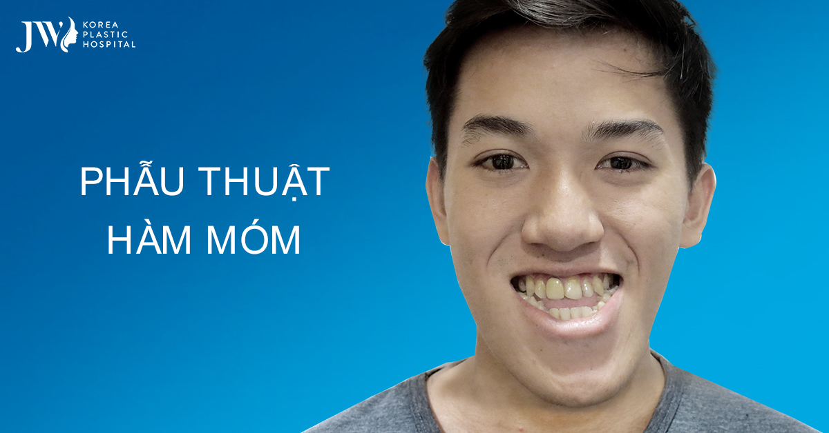 Phẫu Thuật Hàm Móm Đem Lại Nụ Cười Hoàn Mỹ Cho Bạn