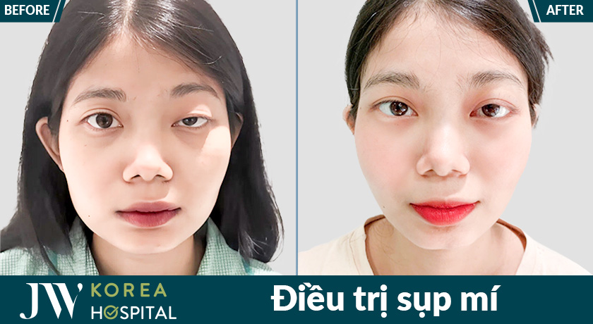 Khắc phục tình trạng mí sụp, lấy lại ánh nhìn linh hoạt tại Bệnh viện JW