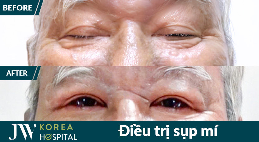 Hình ảnh khách hàng bệnh viện JW trước và sau khi điều trị sụp mi 