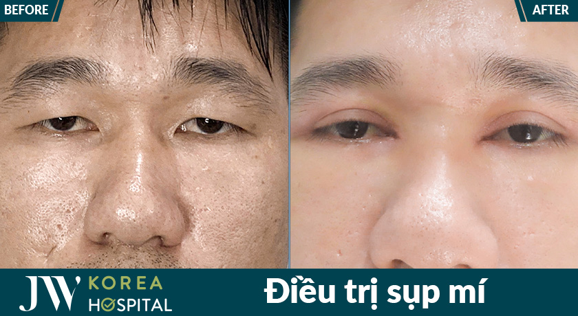 Khách hàng cải thiện sụp mi rõ rệt sau điều trị tại bệnh viện JW